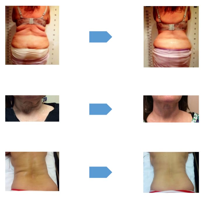 https://www.lymphaticsmassagema.com/wp-content/uploads/2015/06/Northampton-Cavitation-Liposuction.jpg